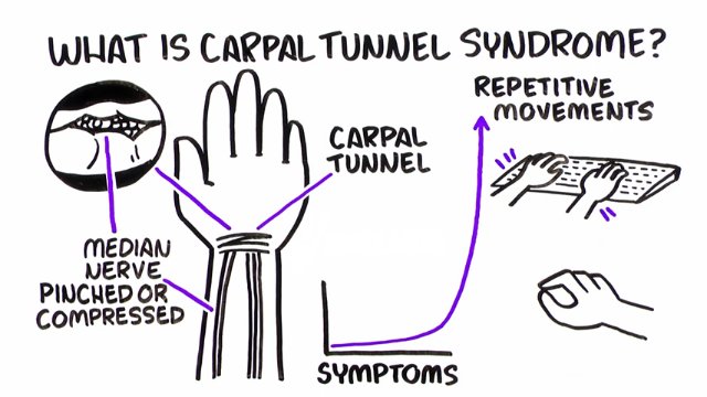 Carpal Tunnel Syndrome: Symptoms, Nerve Conduction Study & Treatment Algorithm